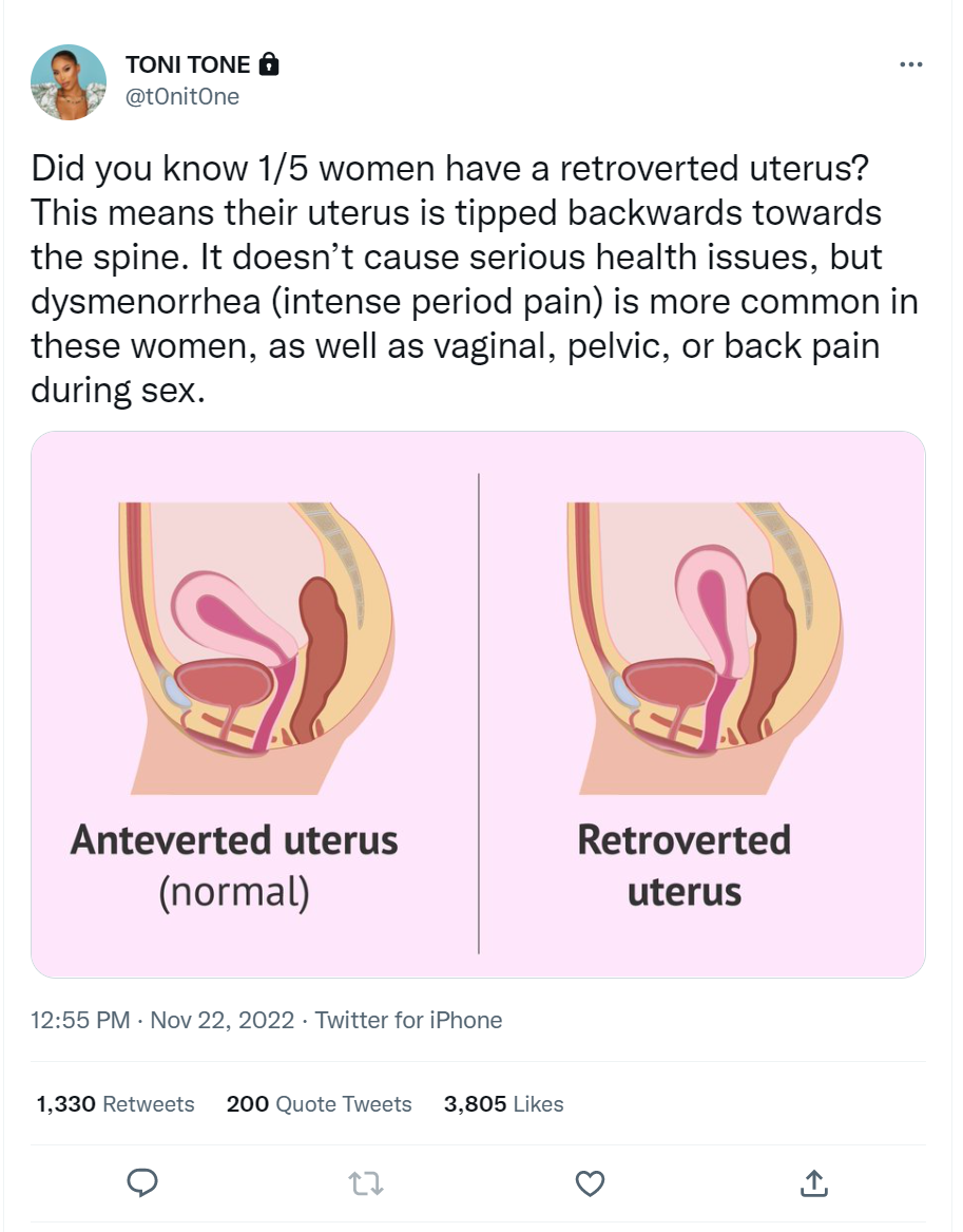 One in five women has a retroverted uterus, which can cause pain
