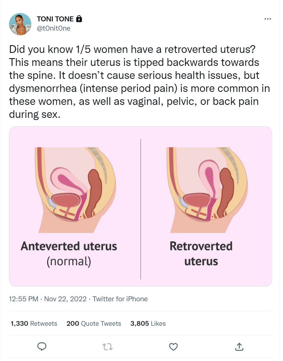 retroverted uterus pregnancy belly